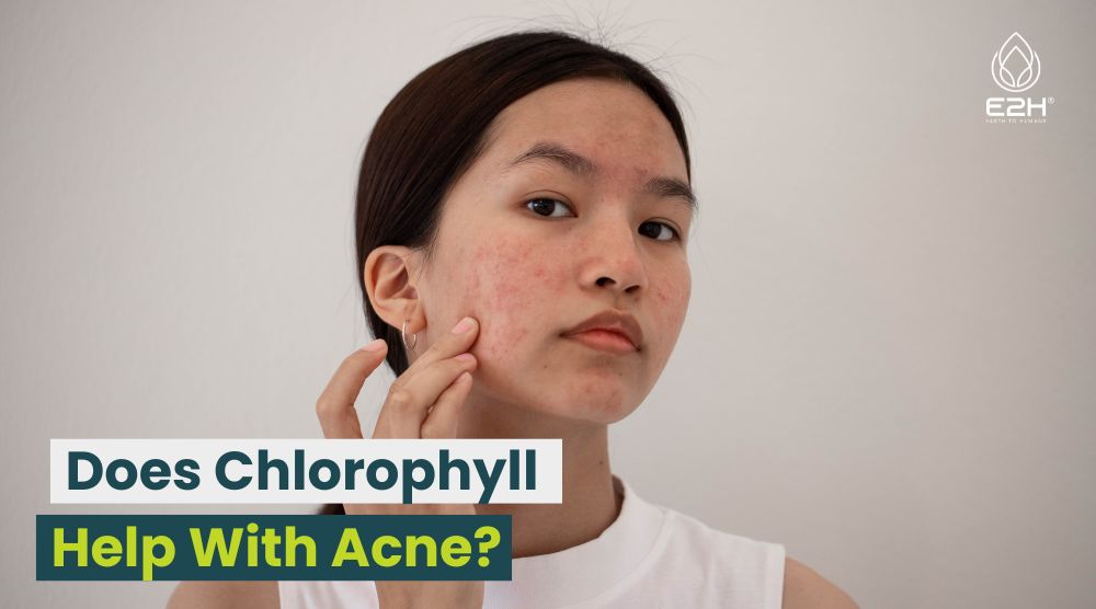 Does Chlorophyll Help With Acne?