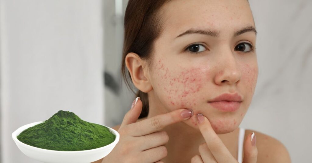 chlorophyll and acne