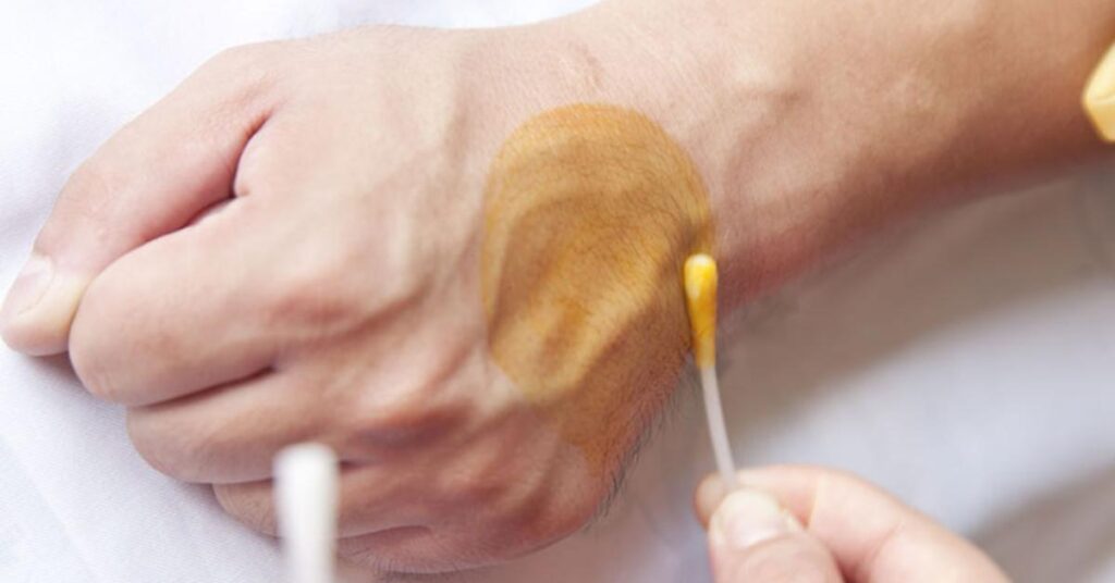 How To Perform The Iodine Patch Test